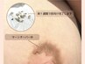 【キャンペーン価格¥132,000】ローマピンク/バストトップ/脇/ヒップ下