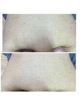 エムリシェ(M.riche)/背中ハーブピーリング