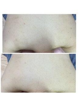 エムリシェ(M.riche)/背中ハーブピーリング