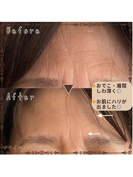 プライベートサロン レイ(Ray)/小顔コース＋オプションくまケア