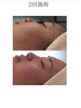 ルアナ(Luana)/ガリレオピーリング