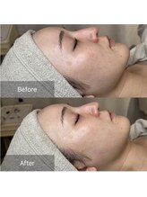 ホワイトアクア 梅田本店(WHITE AQUA)/ララピール/大阪/梅田/毛穴/小顔