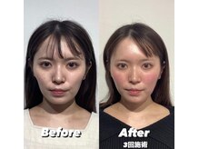 コルミチョン サロン(骨美整 salon)/コケ改善施術　Before・After &nbsp;