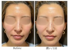 ビボーラ(BEBEAURA)/☆潤いフェイシャル☆