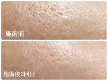 キーオブフェイス(Key of Face)/お悩み【毛穴開き】