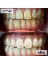 LBSホワイトニング 錦糸町店/ホワイトニングビフォーアフター