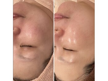 トータルエステティック ジョワイユ(JOYEUX)/ハリ、ツヤ、透明感