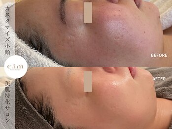 エイム(e.i.m)/30代：赤み/肌荒れ