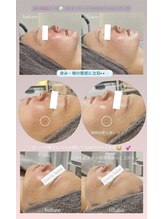 クレヴィー(Creviy)/陶肌ピール1回