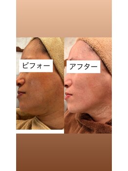 ボディデザイン ビィーラボ(BODY Design BE Labo)/インモードリフト