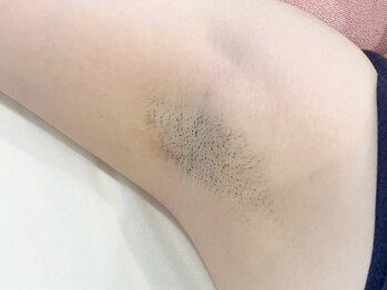 シルク(Cilk)/ワキ脱毛