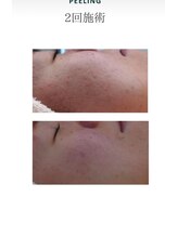 ルアナ(Luana)/ガリレオピーリング