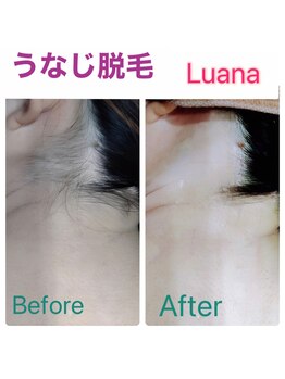 ルアナ(Luana)/うなじ脱毛☆