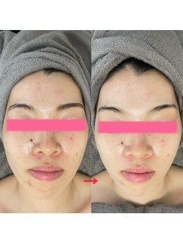 ダリア(Dahlia)/ハーブピーリング