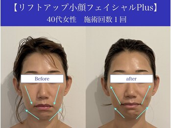 リプロ(RePro)/40代 ビフォーアフター