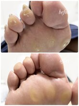 リゼラアンドコー 布施店/足裏のタコ、たくさん！