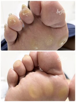 リゼラアンドコー 布施店/足裏のタコ、たくさん！