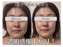 ルリアン(Lurian)/エステ1回でのBefore→After