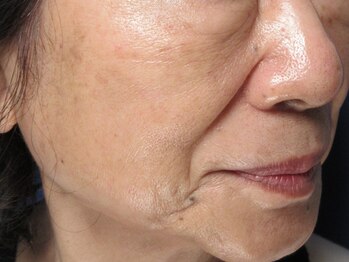 エステティックガーデン小町ストーリー/シミしわ毛穴改善【アフター】