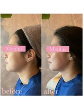 ミープラス(Me+)/小顔マイクロ波リフト