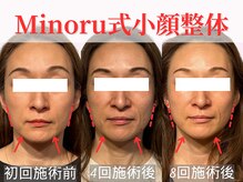 フレキシボディ(FlexiBody)/小顔施術ビフォーアフター #7