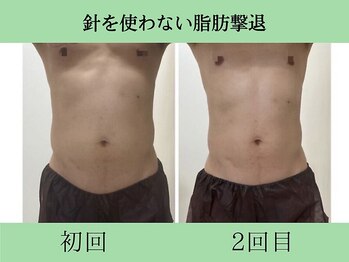 ソルニスクア(Solnis.qua)/痩身☆脂肪分解/ハイパーナイフ