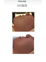 ルアナ(Luana)/ガリレオピーリング