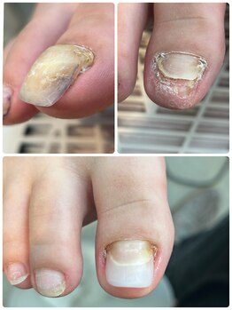 ココ ネイル サロン アンドスクール(COCO.NAIL SALON＆SCHOOL)/トラブル足爪　長さ出し