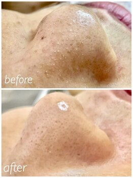 シス(SiS)/ハイドラ/毛穴詰まりケア