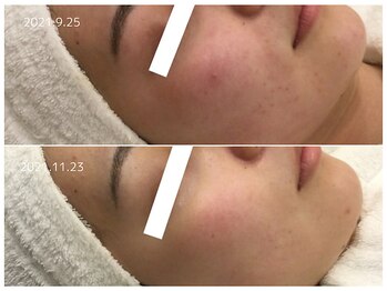 シアン(CYAN)/before/after 赤み