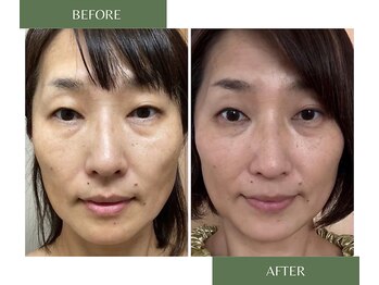 凛/若よもぎ蒸し　Before/After