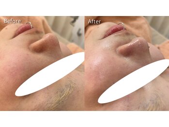 ミュー 春日井店(mieux)/◆肌質改善例