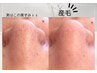 1ヶ月以内☆韓国式3D毛穴洗浄＋部分ワックス脱毛[鼻]通常17400円→7000円