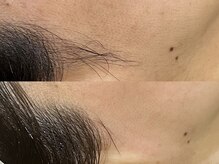 イメロ(imello)/横顔印象アップ/ワックス脱毛