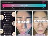 【本気の肌質改善*NOファンデが叶う水光肌へ】プラズマフェイシャル ¥8,500