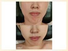 ソウナ(SONA)/厳選国産ハーブピーリング