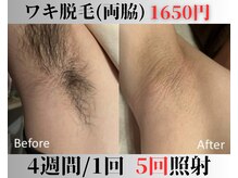 アップパイン(UPPINE)/ワキ脱毛¥1,650