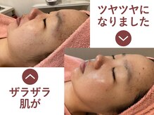 ハッテンビューティーパーク 神戸店(Hatten Beauty Park 810)の雰囲気（肌質改善メニュー）