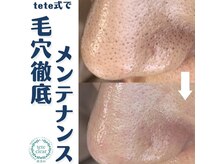 ビビ(VIVI)/毛穴ケアにララピーリング