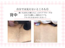 アルゴ 熊本玉名店(ALGO)/【背中】脱毛10回目で効果絶大