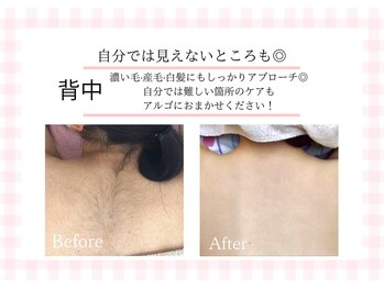 アルゴ 熊本玉名店(ALGO)/【背中】脱毛10回目で効果絶大