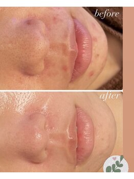 雅菜(miyabina)/毛穴洗浄！ニキビケア