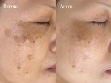 イースト(EAST)/シミプラズマフルコース10回以上