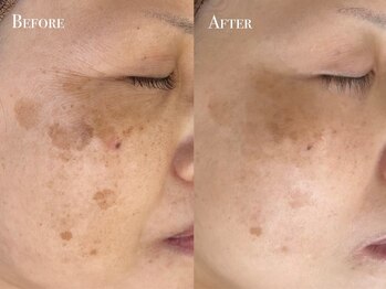 イースト(EAST)/シミプラズマフルコース10回以上