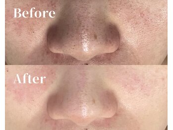 カシェボーテ(CACHE BEAUTE)/黒ずみ毛穴+毛穴引締めケア！