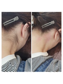 セリシエル(cericiel)/うなじ脱毛