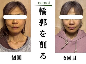 asmot鍼灸 整体院 代々木上原(asmot鍼灸 整体院)/たるみが改善