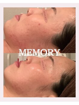メモリー(MEMORY)/ニキビケアに☆