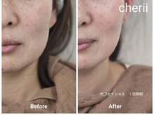 beauty　salon　Cherii【4/1 NEW OPEN（予定）】の雰囲気（光フェイシャル施術１回目）