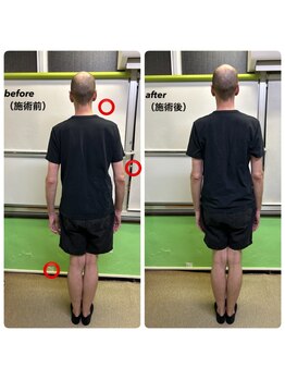 名駅整体院/側弯・歪み（施術前・施術後）